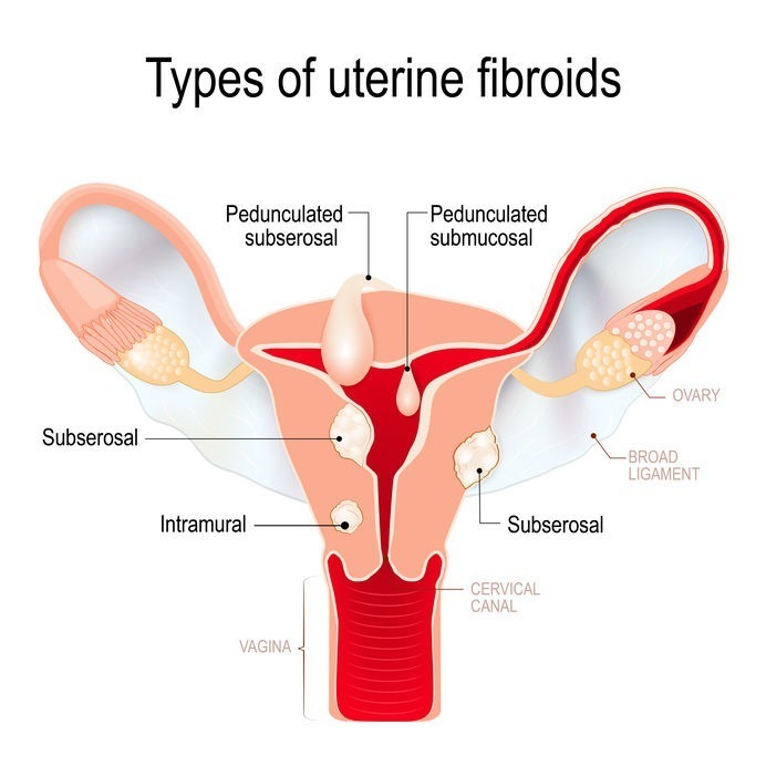 Types Of Uterine Fibroids Things You Need To Know 