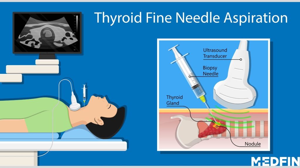 thyroid-diagnosis-treatment-and-recovery-explained