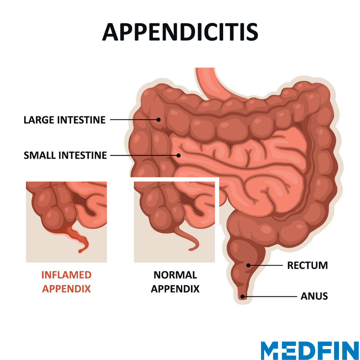 Appendicitis – Understanding The Disease - Medfin