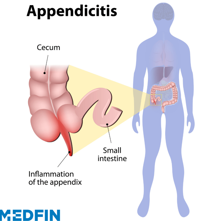 Appendicitis Causes Symptoms And Prevention Medfin