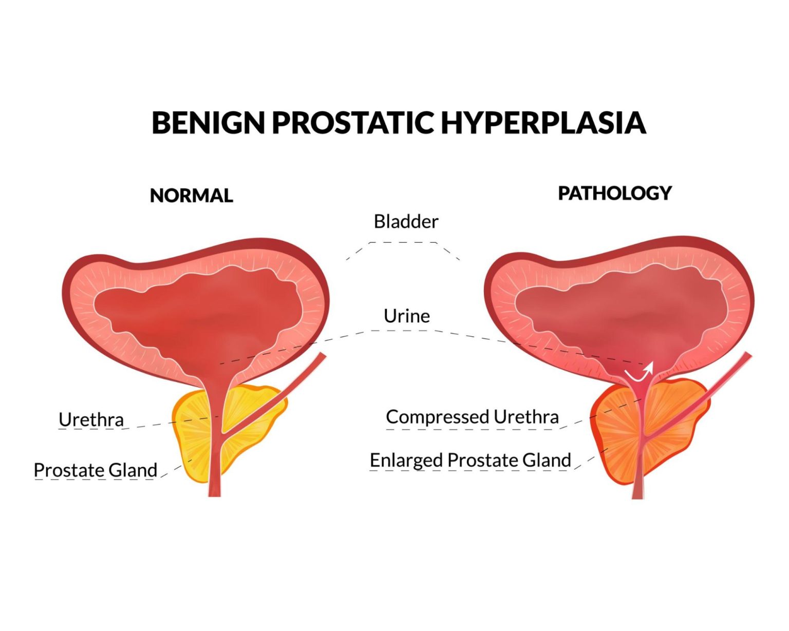 Early Signs Of Benign Prostatic Enlargement Enlarged Prostate Symptoms And Treatments 4096