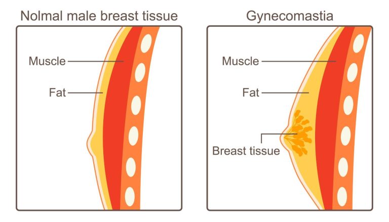 MedfinA Complete Look At The Types Of Gynecomastia Tissue - Medfin