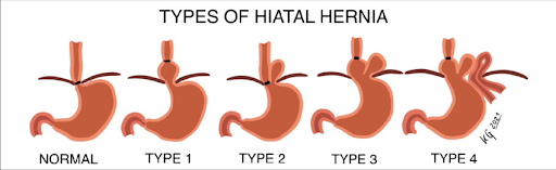 What Size Hiatal Hernia Needs Surgery? | Medfin