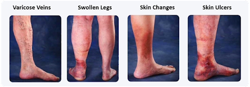 MedfinHow Do Varicose Veins Affect the Skin - Medfin