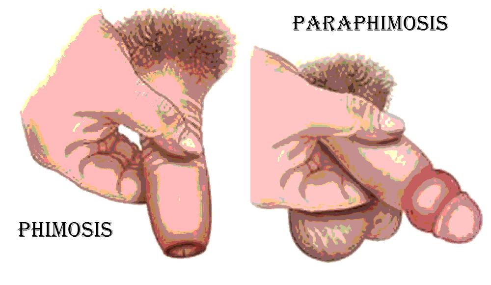 Phimosis  Tight Foreskin - Causes - Symptoms - Diagnosis